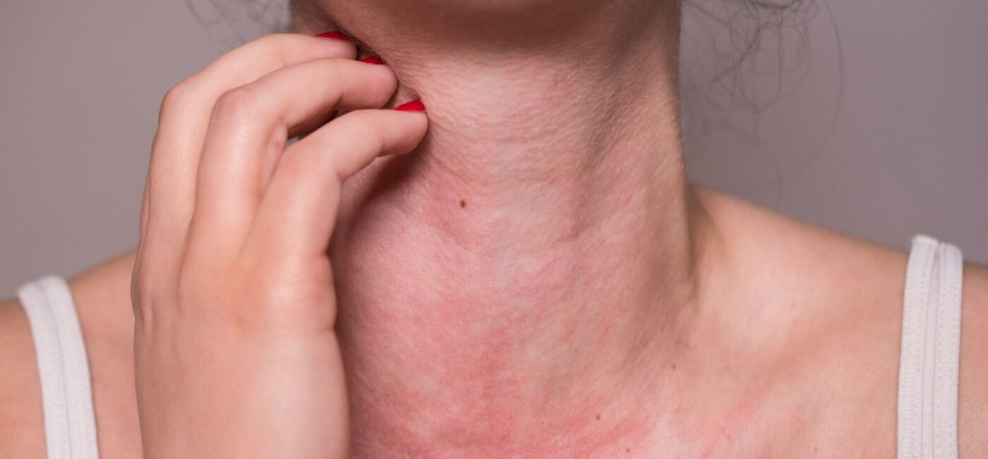Levocetirizine Syrup: A Trusted Allergy Solution